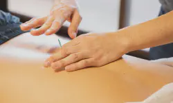 Featured image of post Acupuncture for Running Injuries: An Alternative Approach to Healing